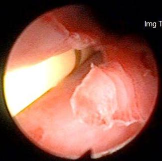 Ectopic ureter kimba0007 Ectopic ureter kimba0007